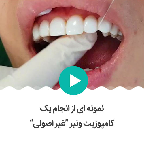 نحوه انجام کامپوزیت دندان